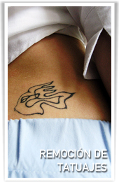 REMOCION DE TATUAJES